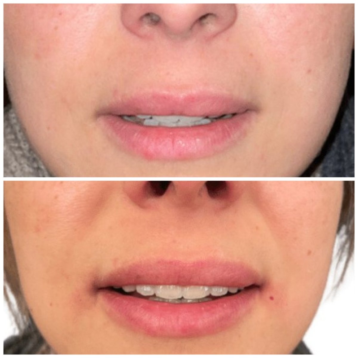 Resultado antes y después de inyección de rellenos en Michaël Benoilid Plastic and Cosmetic Surgeon Paris France