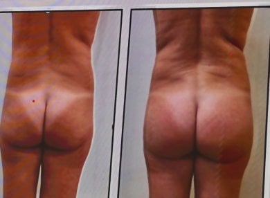 before-after photo gluteoplastika-uvelicenie-agodic