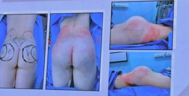 before-after photo gluteoplastika-uvelicenie-agodic
