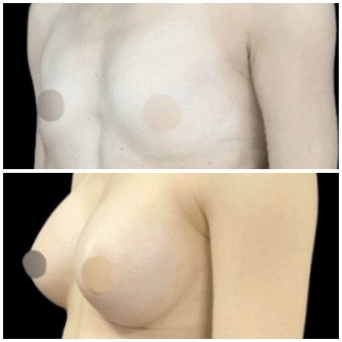 Resultados antes y después de aumento de senos en Michaël Benoilid Plastic and Cosmetic Surgeon Paris