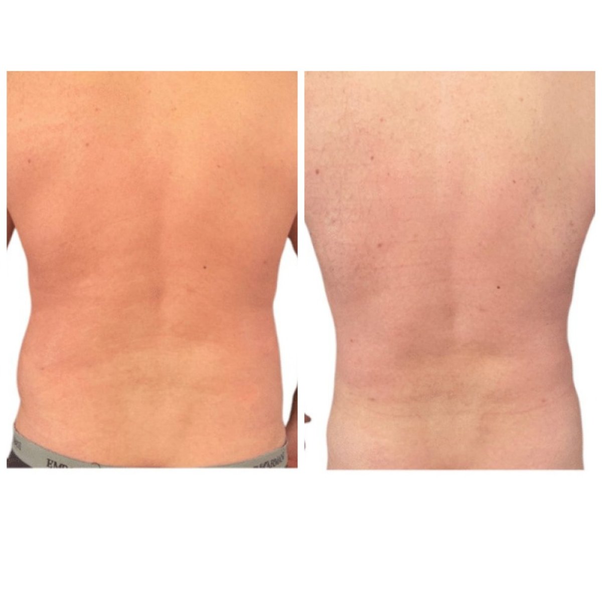 Resultados de liposucción de espalda antes y después en Michaël Benoilid Plastic and Cosmetic Surgeon Paris