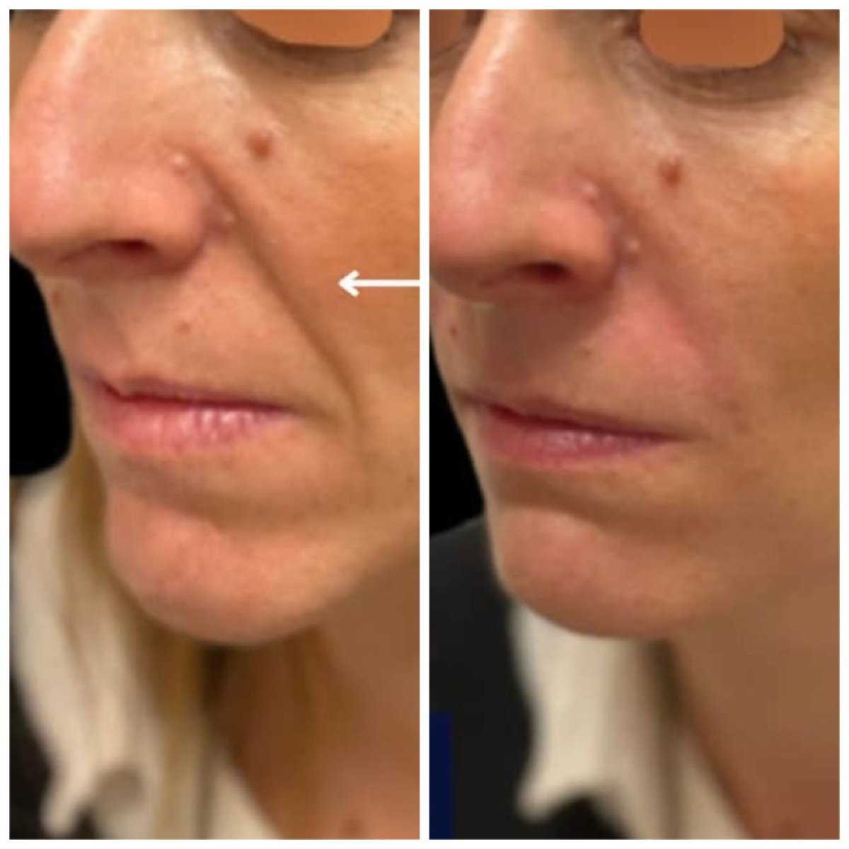 نتيجة قبل وبعد حقن الفيلر في Michaël Benoilid Plastic and Cosmetic Surgeon Paris France