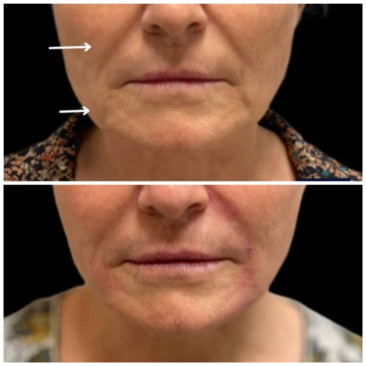 نتيجة قبل وبعد حقن الفيلر في Michaël Benoilid Plastic and Cosmetic Surgeon Paris France