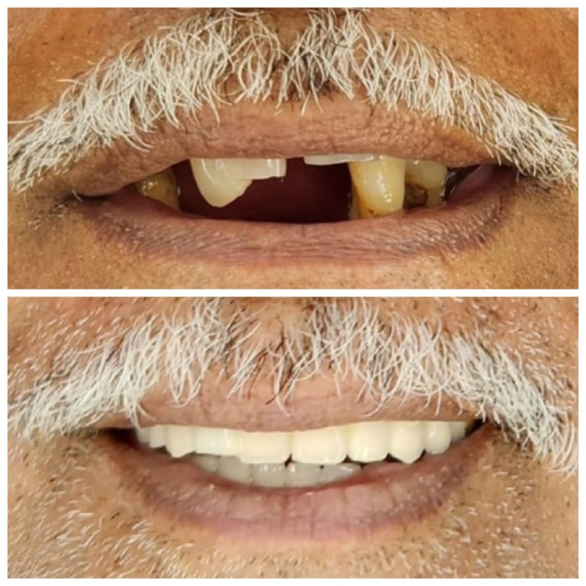 Resultados antes y después de implantes dentales All-on-6: sonrisa y dientes restaurados