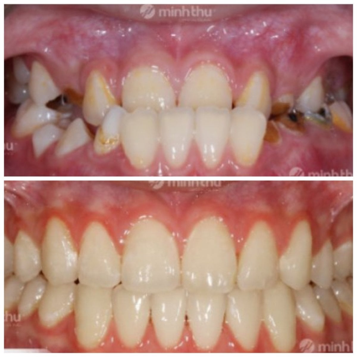 Resultados de antes y después de Invisalign en Minh Thu Dental Clinic, alineación mejorada