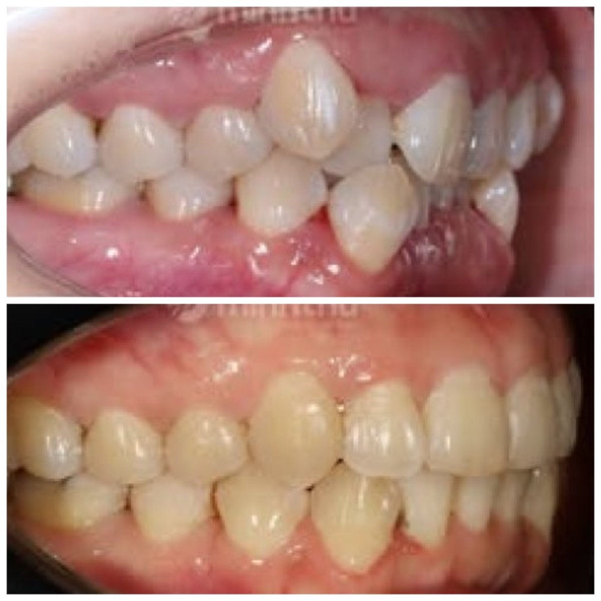 نتائج قبل وبعد تقويم الأسنان الشفاف في Minh Thu Dental Clinic، تحسين انتظام الأسنان