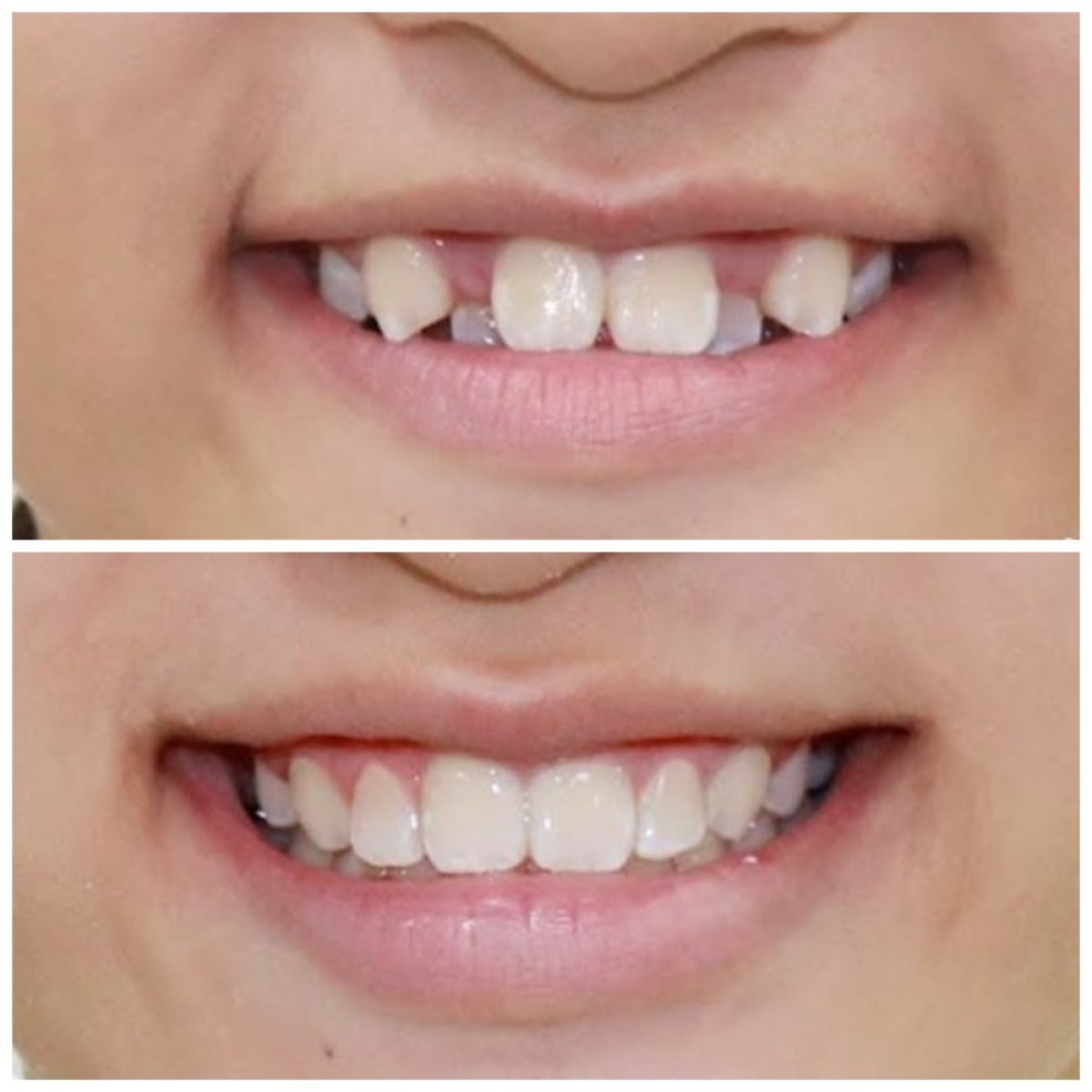 Resultados antes y después de brackets en Minh Thu Dental Clinic – alineación dental mejorada