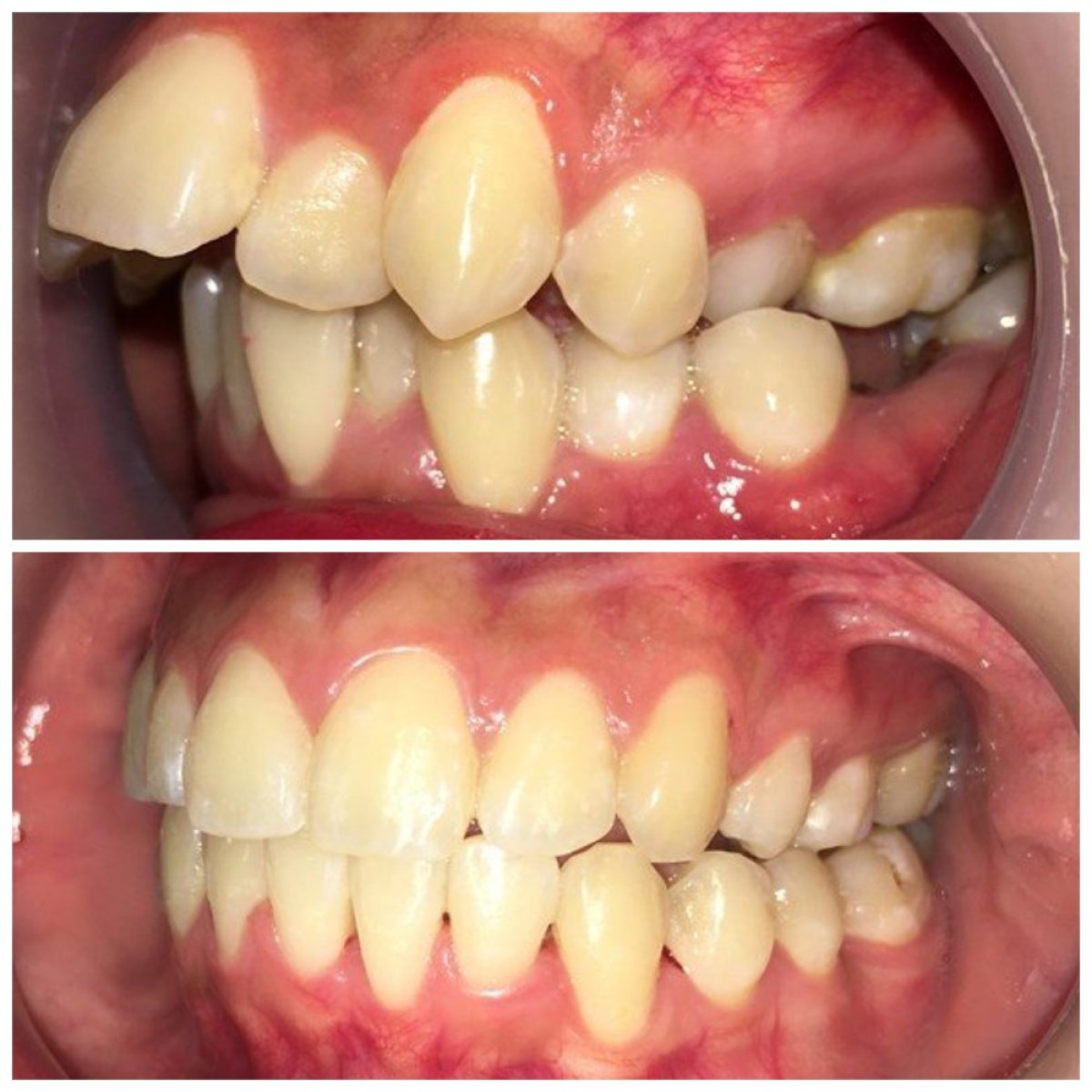 نتائج قبل وبعد تقويم الأسنان في Minh Thu Dental Clinic – تحسين انتظام الأسنان