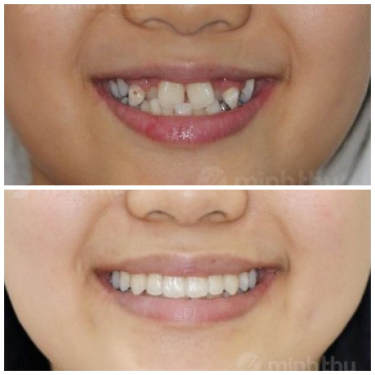 قبل وبعد تقويم الأسنان للمراهقين في Minh Thu Dental Clinic، تحسن واضح في الابتسامة