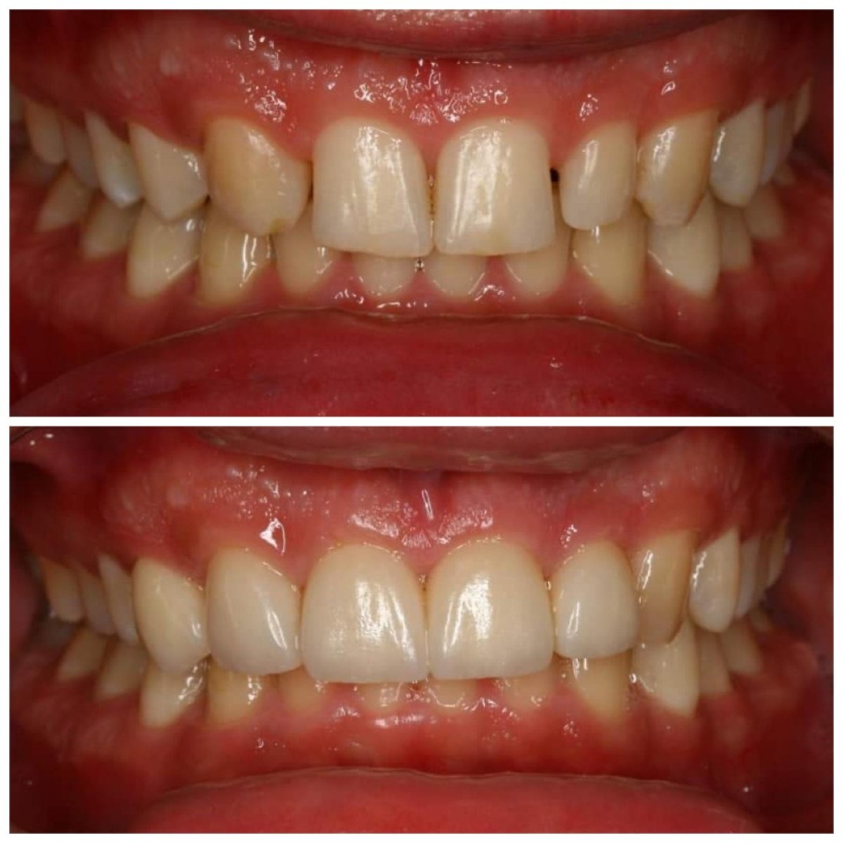 Resultados antes y después de carillas Emax en Minh Thu Dental Clinic, sonrisa mejorada