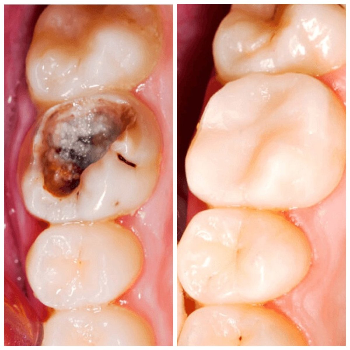 Resultados antes y después de empaste dental compuesto en Minh Thu Dental Clinic