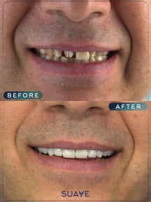 before-after photo all-on-6-dental-implants