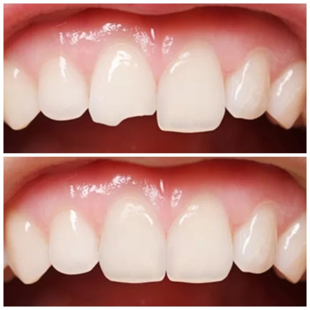 قبل وبعد الفينير في Minh Thu Dental Clinic، نتيجة ترميم سن مكسور