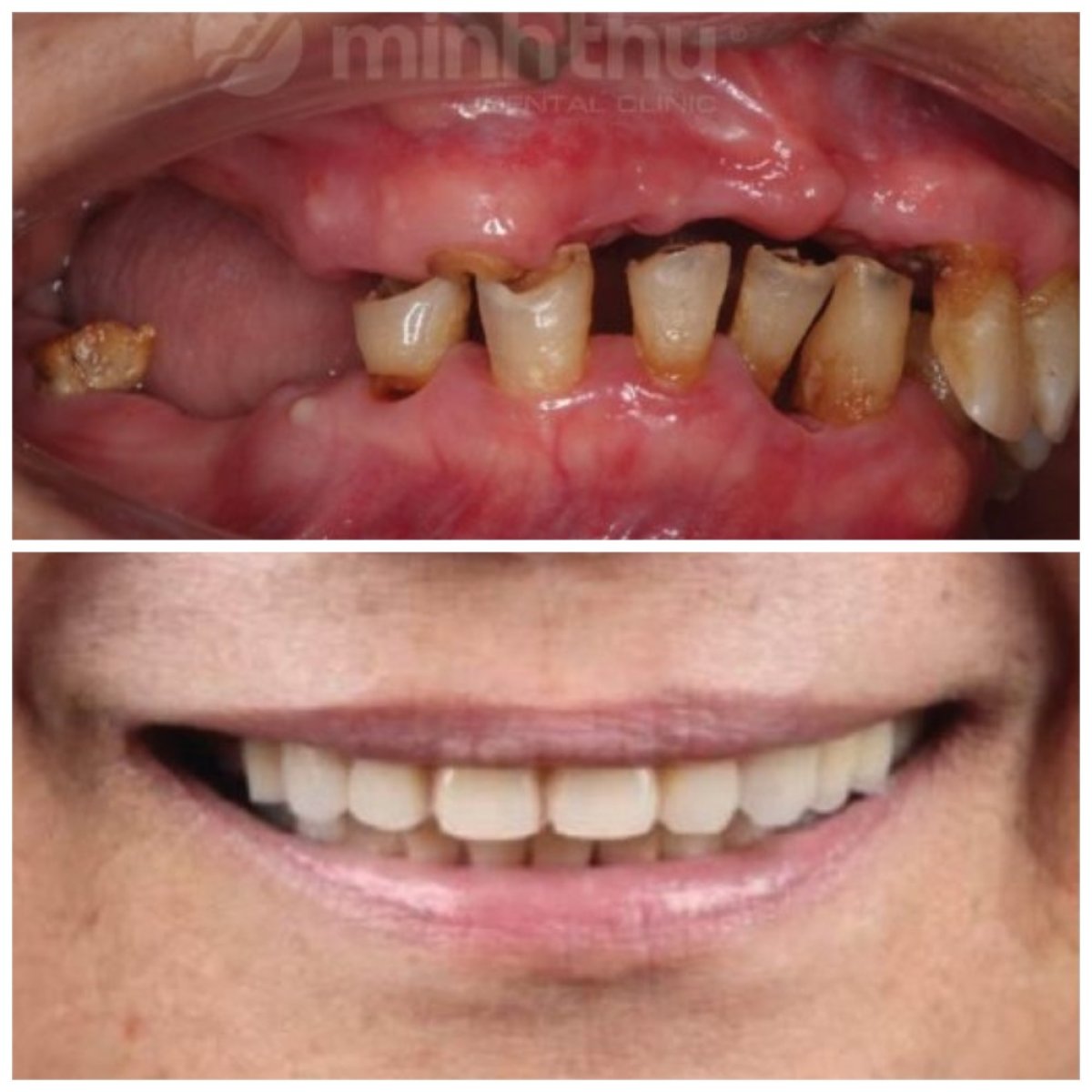Resultados antes y después de implantes dentales en Minh Thu Dental Clinic, sonrisa restaurada