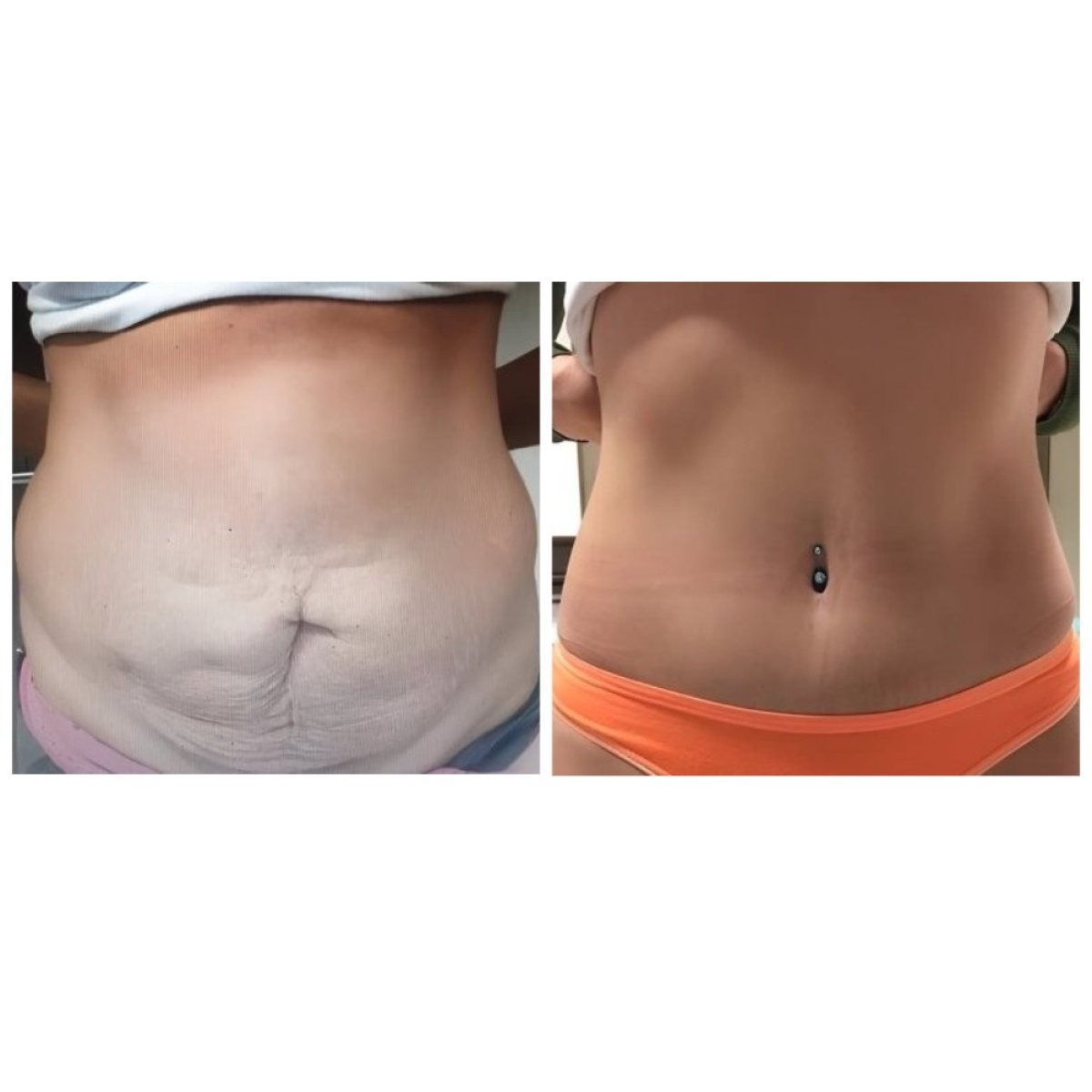 Resultados antes y después de abdominoplastia y liposucción en MEDICTERREAN Clinic Center