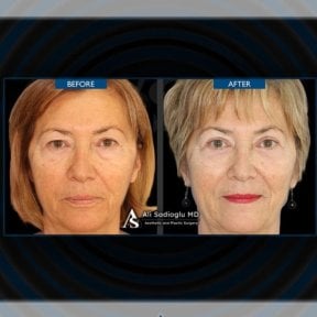 before-after photo upper-and-lower-eyelid-surgery