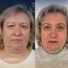 before-after photo upper-and-lower-eyelid-surgery