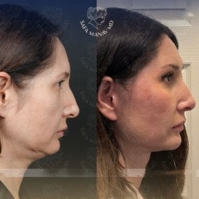 before-after photo deep-plane-facelift