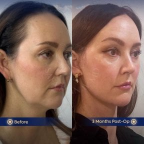before-after photo deep-plane-facelift
