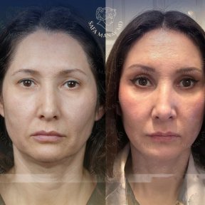 before-after photo deep-plane-facelift