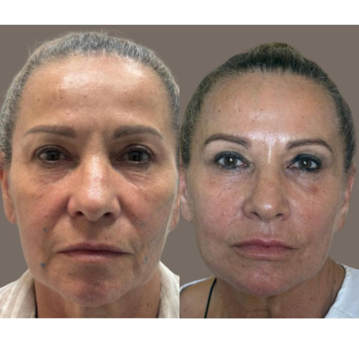 قبل وبعد حقن البوتوكس في ICA، Instituto de Cirugía Estética Avanzada، نتيجة تجديد الوجه