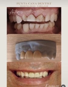 before-after photo smile-makeover