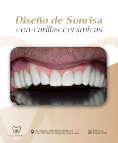 before-after photo smile-makeover