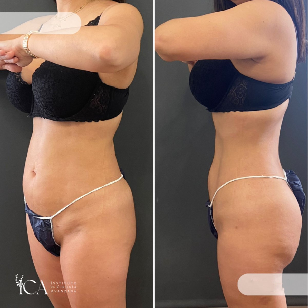 Resultados de liposucción antes y después en ICA, Instituto de Cirugía Estética Avanzada, contorno corporal