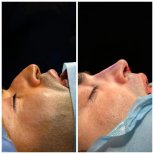 نتائج تجميل الأنف قبل وبعد في Uniqus Health، تحسين شكل ومظهر الأنف