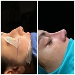نتائج عملية تجميل الأنف قبل وبعد في Uniqus Health، تحسين شكل ومظهر الأنف