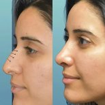 نتائج تجميل الأنف قبل وبعد في Istanbul Care، إعادة تشكيل الأنف بمظهر طبيعي