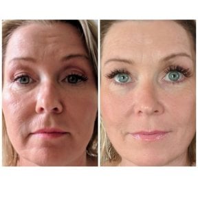 before-after photo stem-cell-rejuvenation-therapy