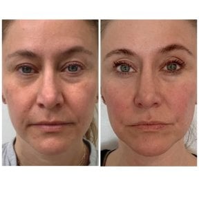 before-after photo stem-cell-rejuvenation-therapy