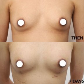 Before and after breast augmentation with fat transfer at Wansiri Hospital, 7-day result