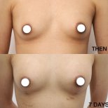 Before and after breast augmentation with fat transfer at Wansiri Hospital, 7-day result
