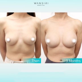 Before and after breast augmentation with fat transfer at Wansiri Hospital, 3-month result