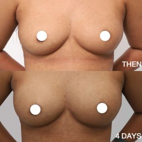 Before and after breast augmentation with fat transfer at Wansiri Hospital, visible results