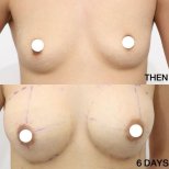 Before and after breast augmentation with fat transfer at Wansiri Hospital, visible results
