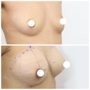 Before and after breast augmentation with fat transfer at Wansiri Hospital, natural results
