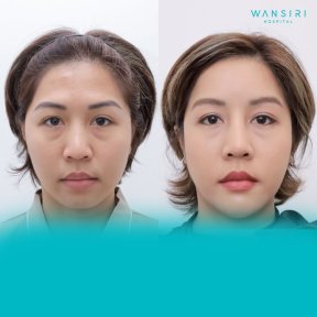 before-after photo forehead-augmentation-implant