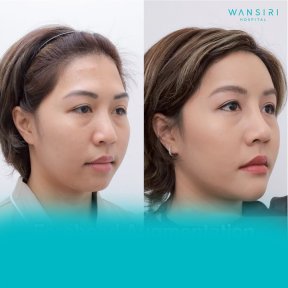 before-after photo forehead-augmentation-implant