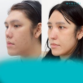 before-after photo forehead-augmentation-implant