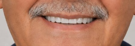 Resultado de instalación de dentadura completa en Punta cana dentist odontologia familiar, sonrisa restaurada