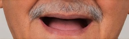 Antes de la instalación de dentaduras completas en Punta cana dentist odontologia familiar, faltan dientes