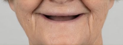 Antes de la instalación de dentaduras completas en Punta cana dentist odontologia familiar, faltan dientes