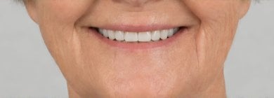 Resultado de instalación de dentadura completa en Punta cana dentist odontologia familiar – sonrisa restaurada