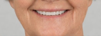 Resultado de instalación de dentadura completa en Punta cana dentist odontologia familiar – sonrisa restaurada