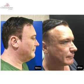 before-after photo liposuction