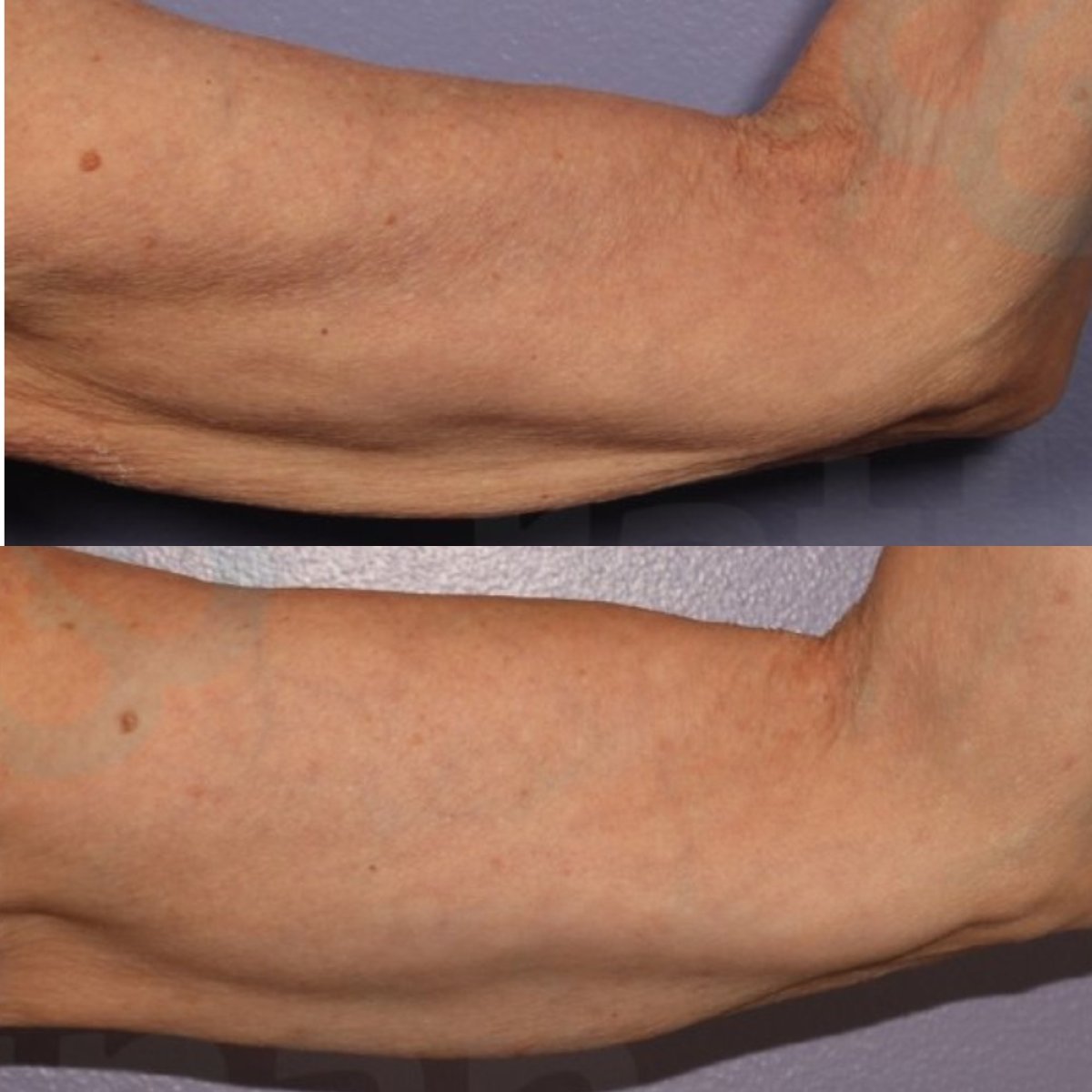 Resultados de lifting de brazos antes y después en Sarinya Clinic, contorno mejorado