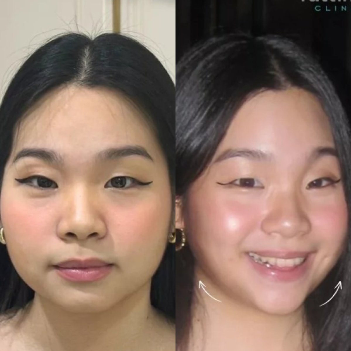Resultados de Thermage antes y después en Sarinya Clinic – mejora del contorno facial